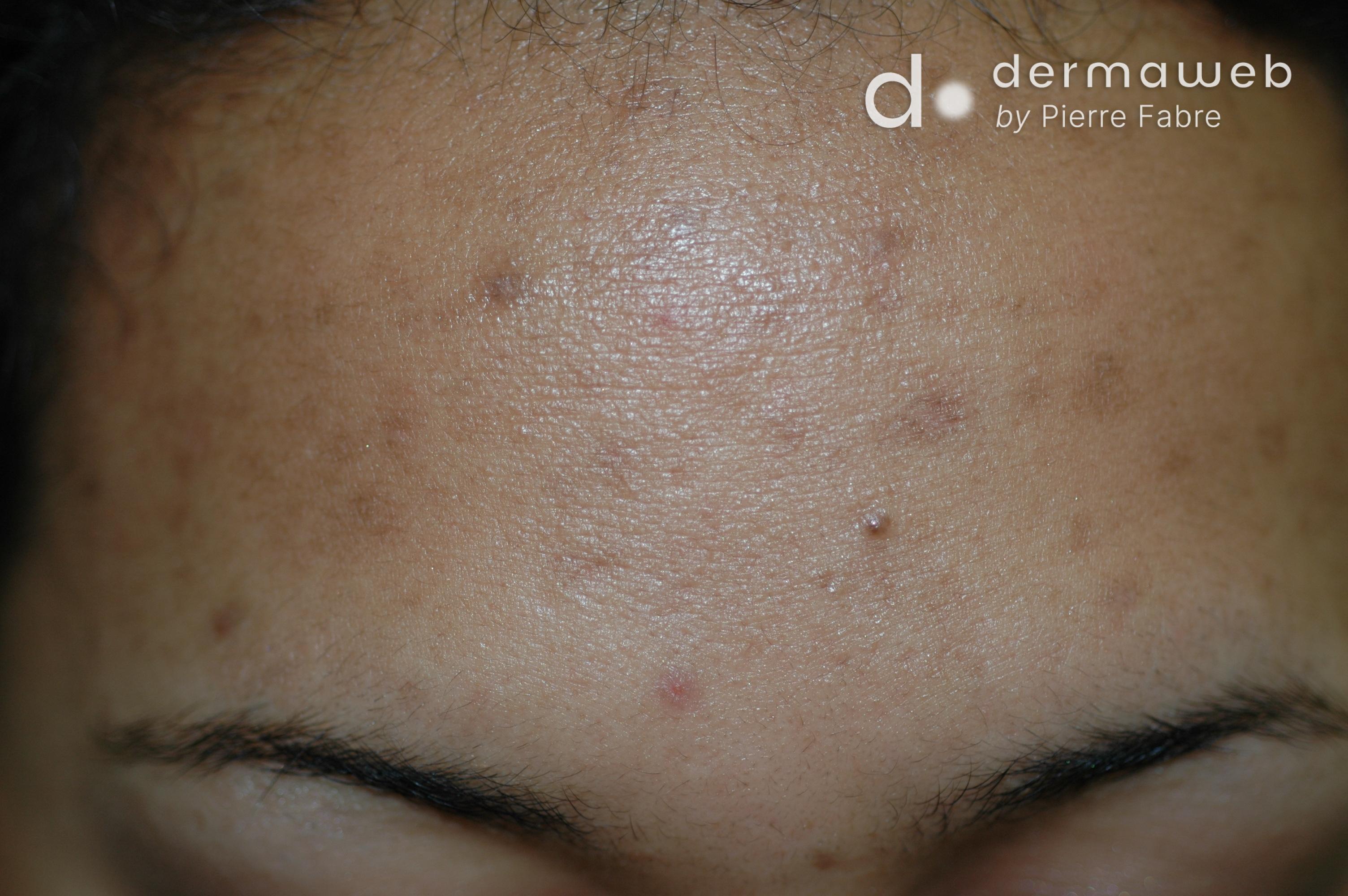 Acné e hiperpigmentaciones posinflamatorias